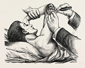 excision of the elbow, the clearing of the humerus, medical equipment, surgical instrument excision of the elbow, the clearing of the humerus, medical equipment, surgical instrument