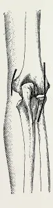 excision the elbow is now extended, medical equipment, surgical instrument, history excision the elbow is now extended, medical equipment, surgical instrument, history