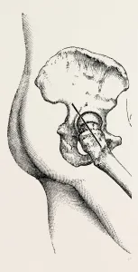 excision of the hip, medical equipment, surgical instrument, history of medicine excision of the hip, medical equipment, surgical instrument, history of medicine