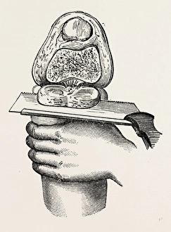 excision of the knee, medical equipment, surgical instrument, history of medicine excision of the knee, medical equipment, surgical instrument, history of medicine