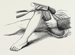 excision of the knee, the sawing of the lower end, medical equipment, surgical instrument excision of the knee, the sawing of the lower end, medical equipment, surgical instrument