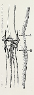 excision, medical equipment, surgical instrument, history of medicine excision, medical equipment, surgical instrument, history of medicine