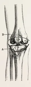 excision of the operation the limb, medical equipment, surgical instrument, history excision of the operation the limb, medical equipment, surgical instrument, history