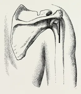 excision of shoulder, medical equipment, surgical instrument, history of medicine excision of shoulder, medical equipment, surgical instrument, history of medicine
