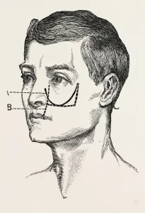 excision of the tipper jaw, medical equipment, surgical instrument, history of medicine excision of the tipper jaw, medical equipment, surgical instrument, history of medicine