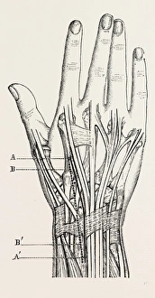 excision of the wrist, medical equipment, surgical instrument, history of medicine excision of the wrist, medical equipment, surgical instrument, history of medicine