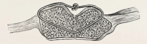 fragments in apposition, the wire knot hammered flat, medical equipment, surgical fragments in apposition, the wire knot hammered flat, medical equipment, surgical
