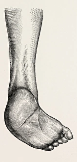incurved form of the foot, the planzar, medical equipment, surgical instrument, history incurved form of the foot, the planzar, medical equipment, surgical instrument, history