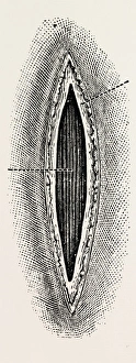 ligatuite of the right radial, medical equipment, surgical instrument, history of ligatuite of the right radial, medical equipment, surgical instrument, history of