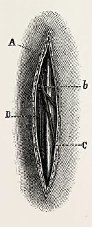ligature, medical equipment, surgical instrument, history of medicine ligature, medical equipment, surgical instrument, history of medicine