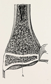 lower end of the radius, medical equipment, surgical instrument, history of medicine lower end of the radius, medical equipment, surgical instrument, history of medicine