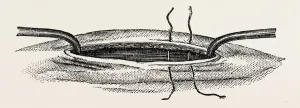 method of steadying the margins of a wound with blunt hooks, medical equipment, surgical method of steadying the margins of a wound with blunt hooks, medical equipment, surgical