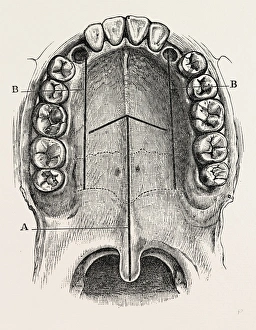 nelatons operation for nasal polypus, medical equipment, surgical instrument nelatons operation for nasal polypus, medical equipment, surgical instrument