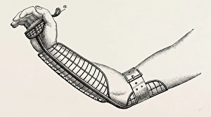 ollieris wire splint for excision of the wrist, medical equipment, surgical instrument ollieris wire splint for excision of the wrist, medical equipment, surgical instrument