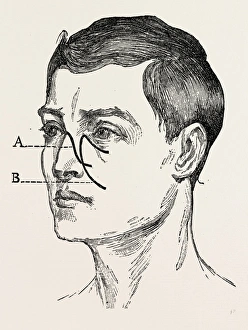 operations for naso-pharyn, medical equipment, surgical instrument, history of medicine operations for naso-pharyn, medical equipment, surgical instrument, history of medicine