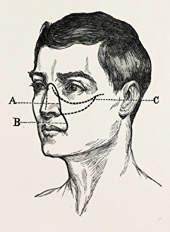 operations for naso-pharyngral, medical equipment, surgical instrument, history of operations for naso-pharyngral, medical equipment, surgical instrument, history of