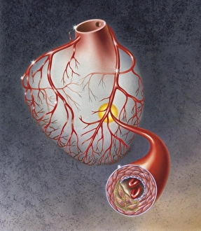 Arteries on heart showing atherosclerotic plaque in an artery Arteries on heart showing atherosclerotic plaque in an artery