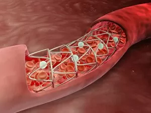 Artery cross-section with blood flow and stent deployment