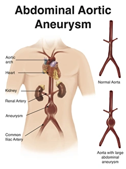 Artist depcition of abdominal aortic aneuryism (with labels) Artist depcition of abdominal aortic aneuryism (with labels)