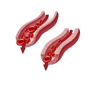 Blood flow through a relaxed artery verus an artery in spasm Blood flow through a relaxed artery verus an artery in spasm
