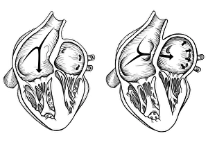 Comparison of normal heart versus heart with a patent foramen ovale Comparison of normal heart versus heart with a patent foramen ovale