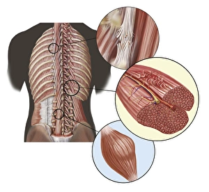Detail of deep back muscles with a close-up of sprain, strain and spasm Detail of deep back muscles with a close-up of sprain, strain and spasm