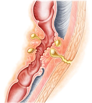 <b class=qtipBold><figcaption>Development of fistula</figcaption></b><br>Development of fistula.<br><em>© Stocktrek Images</em> Development of fistula