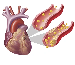 Heart with arteries showing cholesterol in one and plaque in the other Heart with arteries showing cholesterol in one and plaque in the other