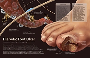 Histopathology and pathophysiology of diabetic food ulcers Histopathology and pathophysiology of diabetic food ulcers