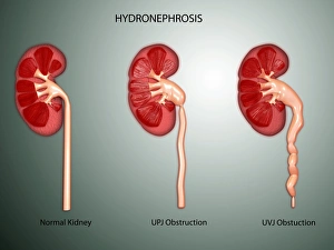 Hydronephrosis condition of the kidney Hydronephrosis condition of the kidney