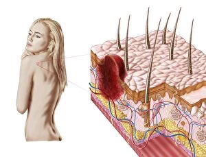 Illustration of an atypical growth on the skin that could be a sign of skin cancer
