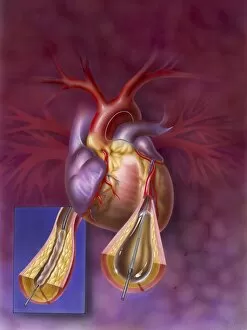 Insertion of balloon into atherosclerotic artery