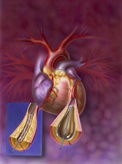 Insertion of balloon into atherosclerotic artery Insertion of balloon into atherosclerotic artery