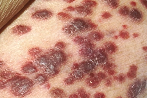 Kaposis sarcoma on the skin of an AIDS patient Kaposis sarcoma on the skin of an AIDS patient