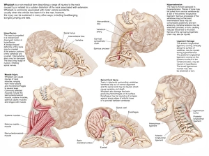 Medical chart showing the range of injuries to the human neck caused by whiplash Medical chart showing the range of injuries to the human neck caused by whiplash