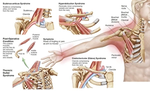 Medical illustration detailing thoracic outlet syndrome Medical illustration detailing thoracic outlet syndrome