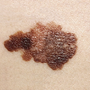 <b class=qtipBold><figcaption>Melanoma on a patient's skin</figcaption></b><br>Melanoma on a patient's skin.<br><em>© National Institutes of Health/Stocktrek Images</em> Melanoma on a patient's skin