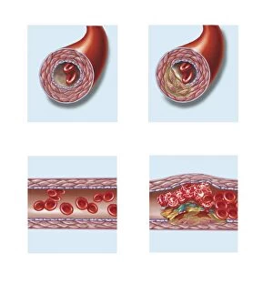 Cholesterol Collection: Normal artery compared to plaque and thrombus formation in artery