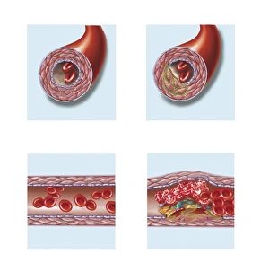 Normal artery compared to plaque and thrombus formation in artery Normal artery compared to plaque and thrombus formation in artery