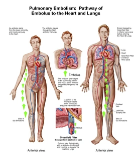 Pulmonary embolism, pathway of embolus to the heart and lungs Pulmonary embolism, pathway of embolus to the heart and lungs