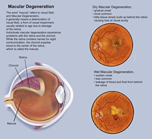<b class=qtipBold><figcaption>Retina with macular degeneration</figcaption></b><br>Retina with macular degeneration.<br><em>© TriFocal Communications/Stocktrek Images</em> Retina with macular degeneration