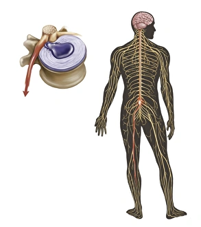 <b class=qtipBold><figcaption>Sciatica caused from herniated disc</figcaption></b><br>Sciatica caused from herniated disc.<br><em>© TriFocal Communications/Stocktrek Images</em> Sciatica caused from herniated disc
