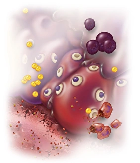 Surrounding tissue becomes inflamed causing several systemic effects Surrounding tissue becomes inflamed causing several systemic effects