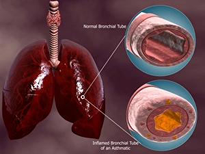 Trachea cross-section with lungs showing normal and asthmatic bronchiole Trachea cross-section with lungs showing normal and asthmatic bronchiole