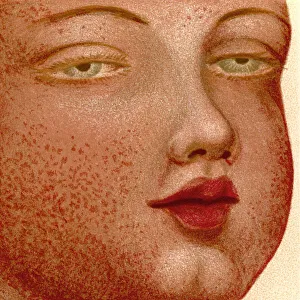 Eruptive Fevers: Scarlatina or Scarlet Fever. From The Household Physician, published c.1898 Eruptive Fevers: Scarlatina or Scarlet Fever. From The Household Physician, published c.1898