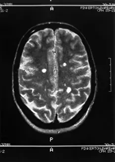 Medical Imaging Techniques Prints: Multiple sclerosis